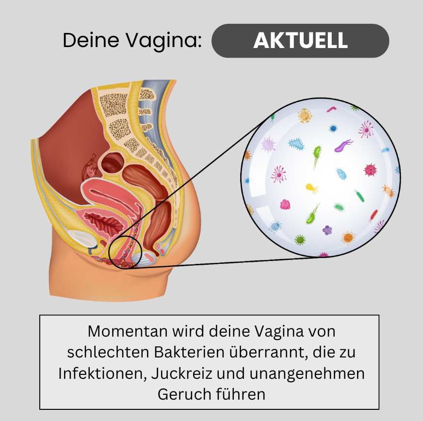 Diagram of female reproductive system highlighting bacterial overgrowth.