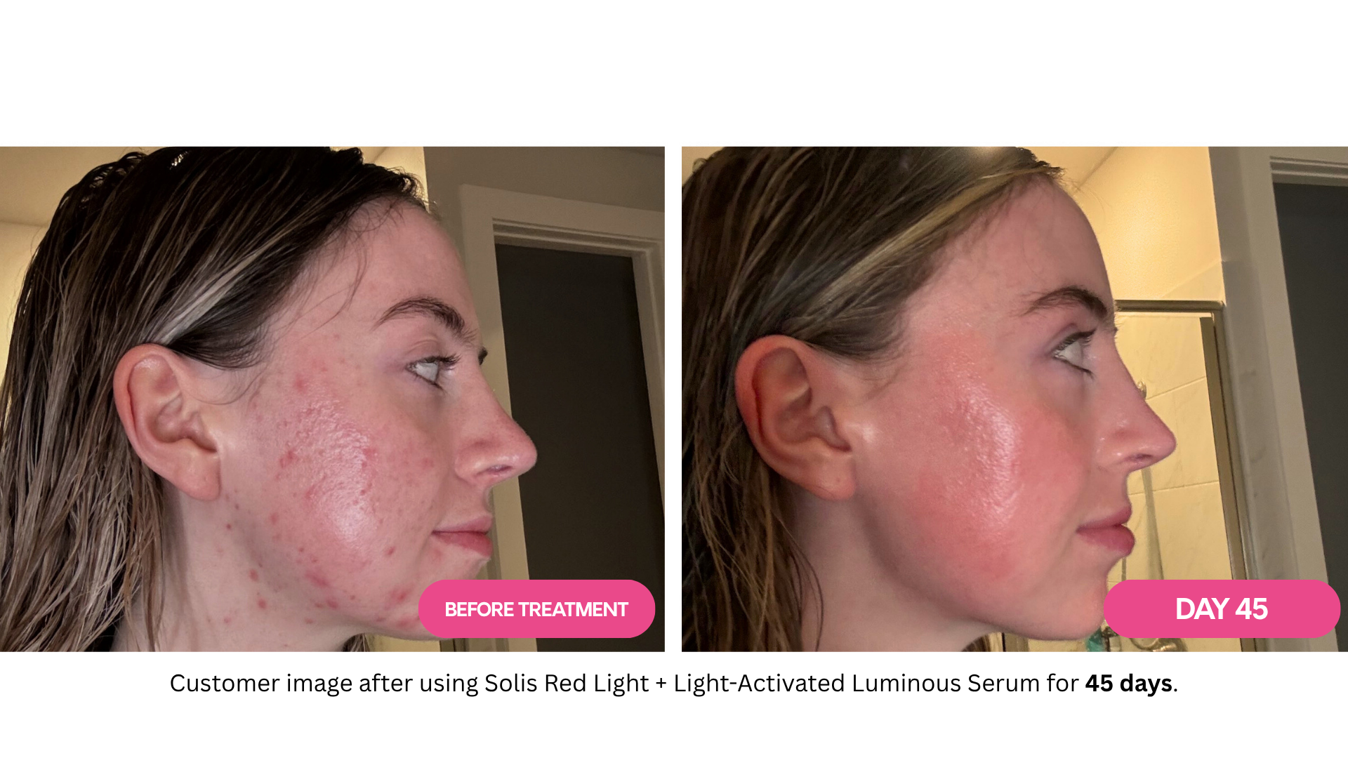 Side-by-side comparison of a woman's face before and after skin treatment.