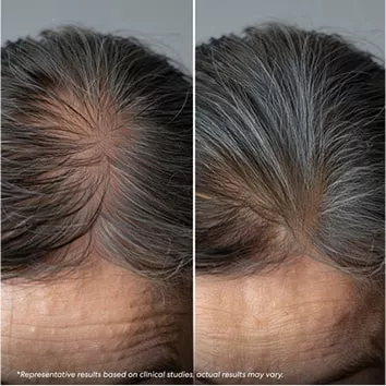 Comparison of a scalp before and after hair growth treatment.