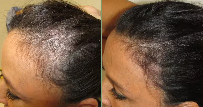 Comparison of hair thinning and regrowth on a woman's scalp.