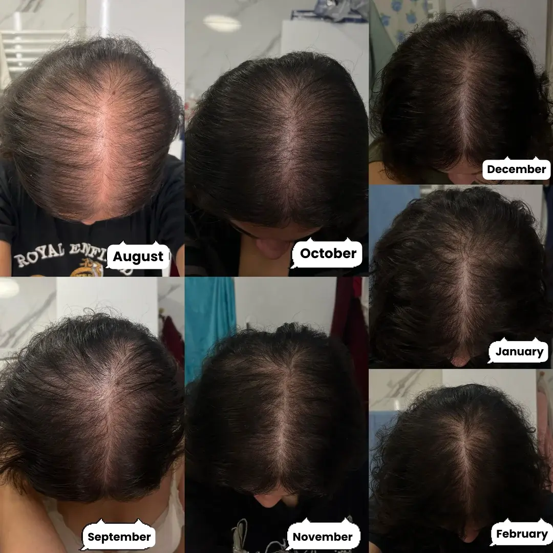 A photo collage showing seven months of hair regrowth on a person's scalp, from August to February.
