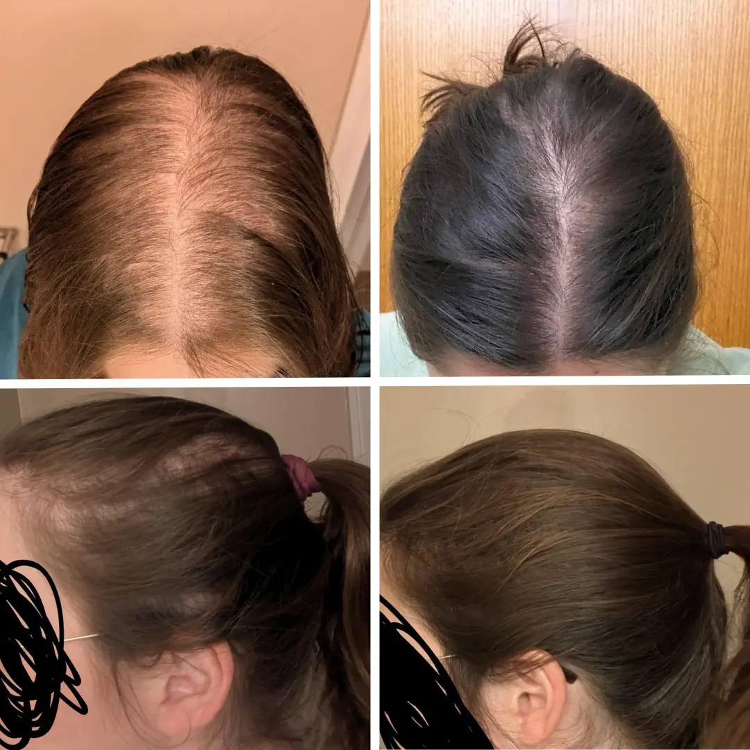 A four-panel grid showing before and after photos of a woman's hair, demonstrating significant hair regrowth.