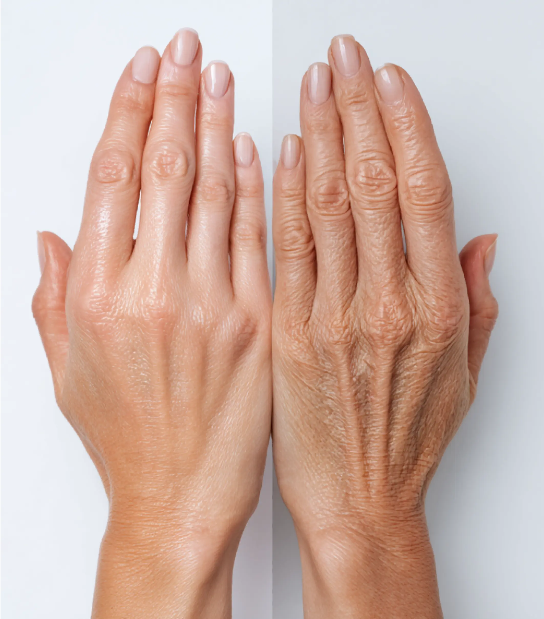 Comparison of two hands showing different skin textures.