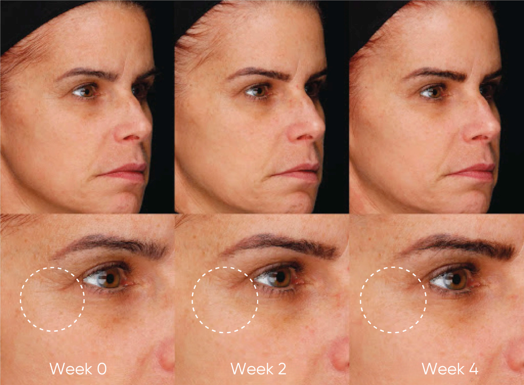 Facial skin improvement over four weeks, showing reduced wrinkles near the eyes.