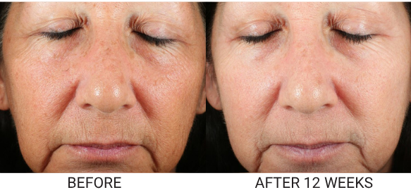 Before and after photos of a woman's face, showing a reduction in wrinkles and sunspots after 12 weeks.
