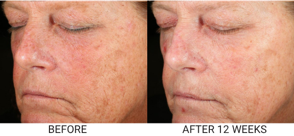 A before and after comparison of a woman's face, showing a reduction in sun spots and wrinkles.