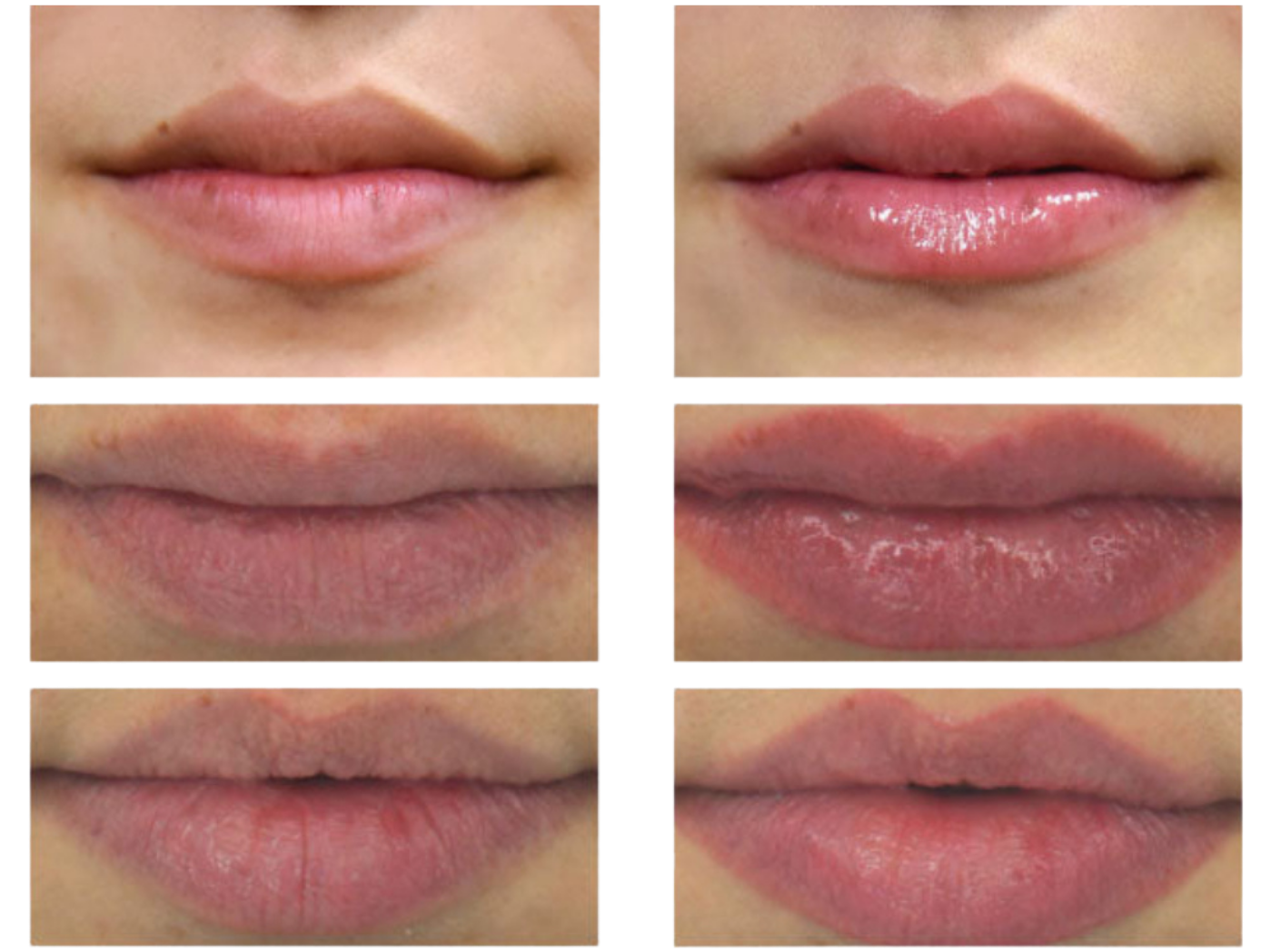 A collage of three sets of before and after photos showing the results of a lip enhancement procedure.