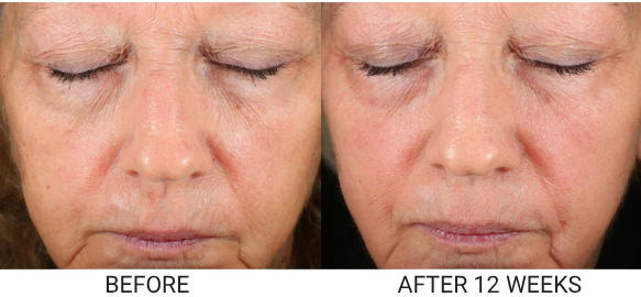 Before and after photos of a woman's face showing a reduction in wrinkles after 12 weeks.