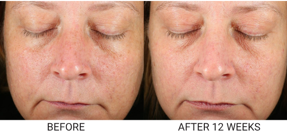 A before and after photo showing a woman's face with reduced skin discoloration after twelve weeks of treatment.