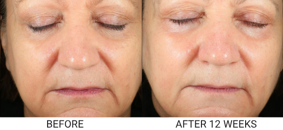 A before and after comparison of a woman's face, showing the skin's appearance after 12 weeks.