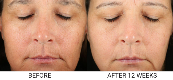 A before and after comparison of a woman's face, showing a reduction in wrinkles after 12 weeks.