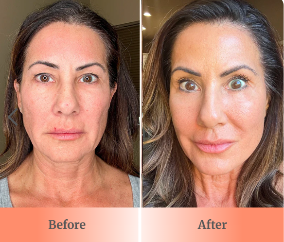 A before and after comparison photo of a woman's face, showing changes in her skin and features.