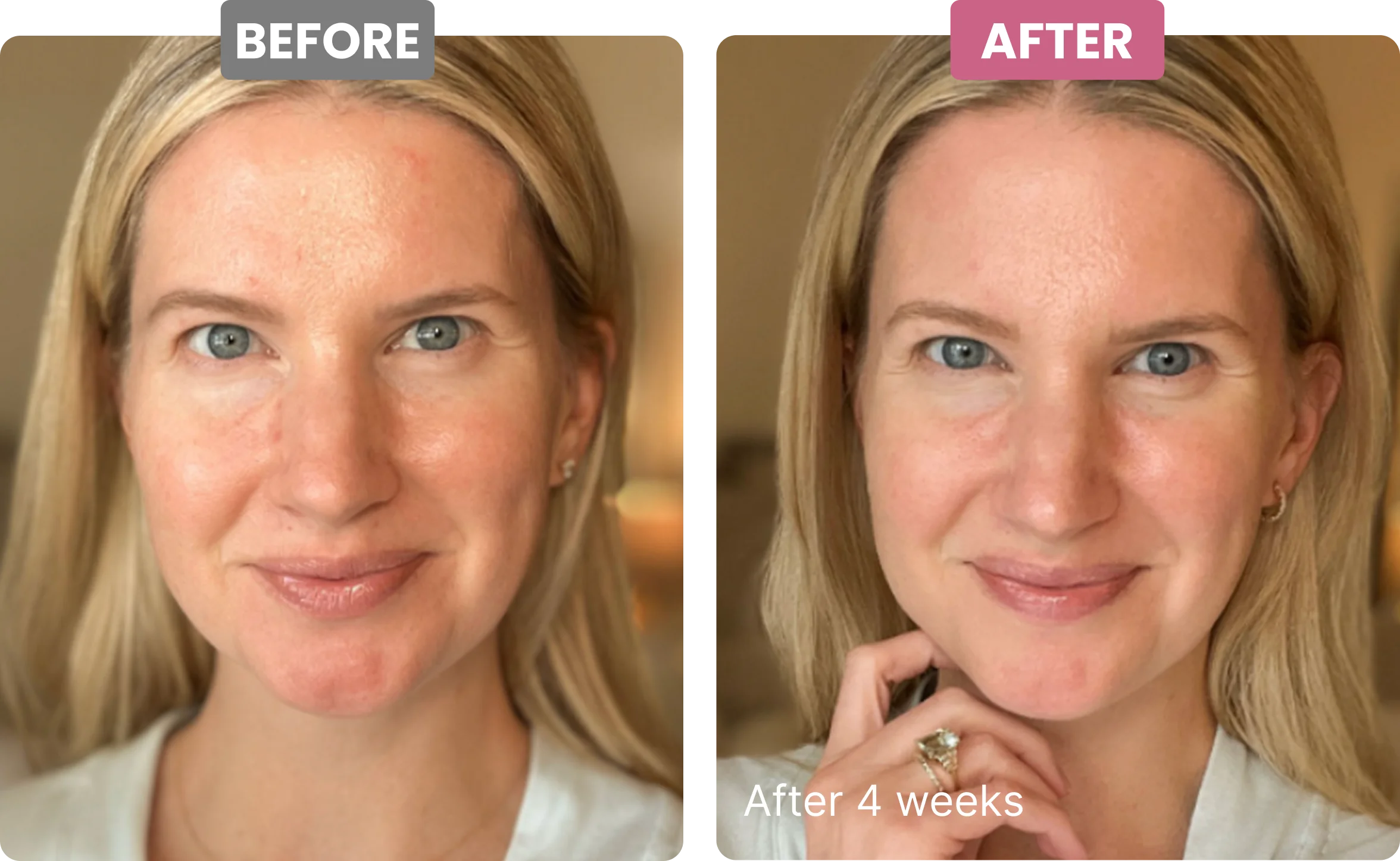 A before and after comparison of a woman's face, showing a visible improvement in her skin's appearance.