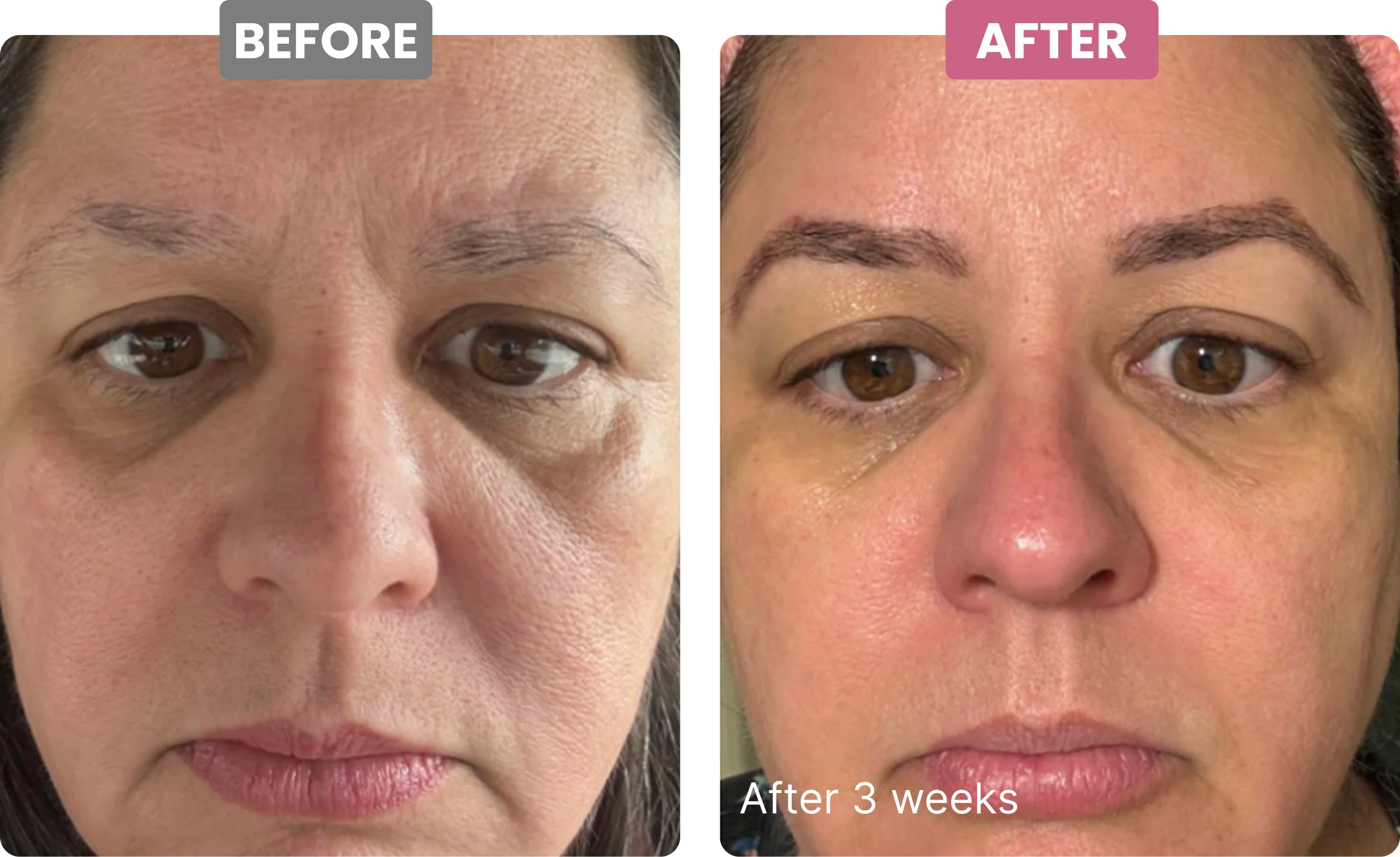 A before and after comparison of a woman's face, showing a reduction in wrinkles after 3 weeks.