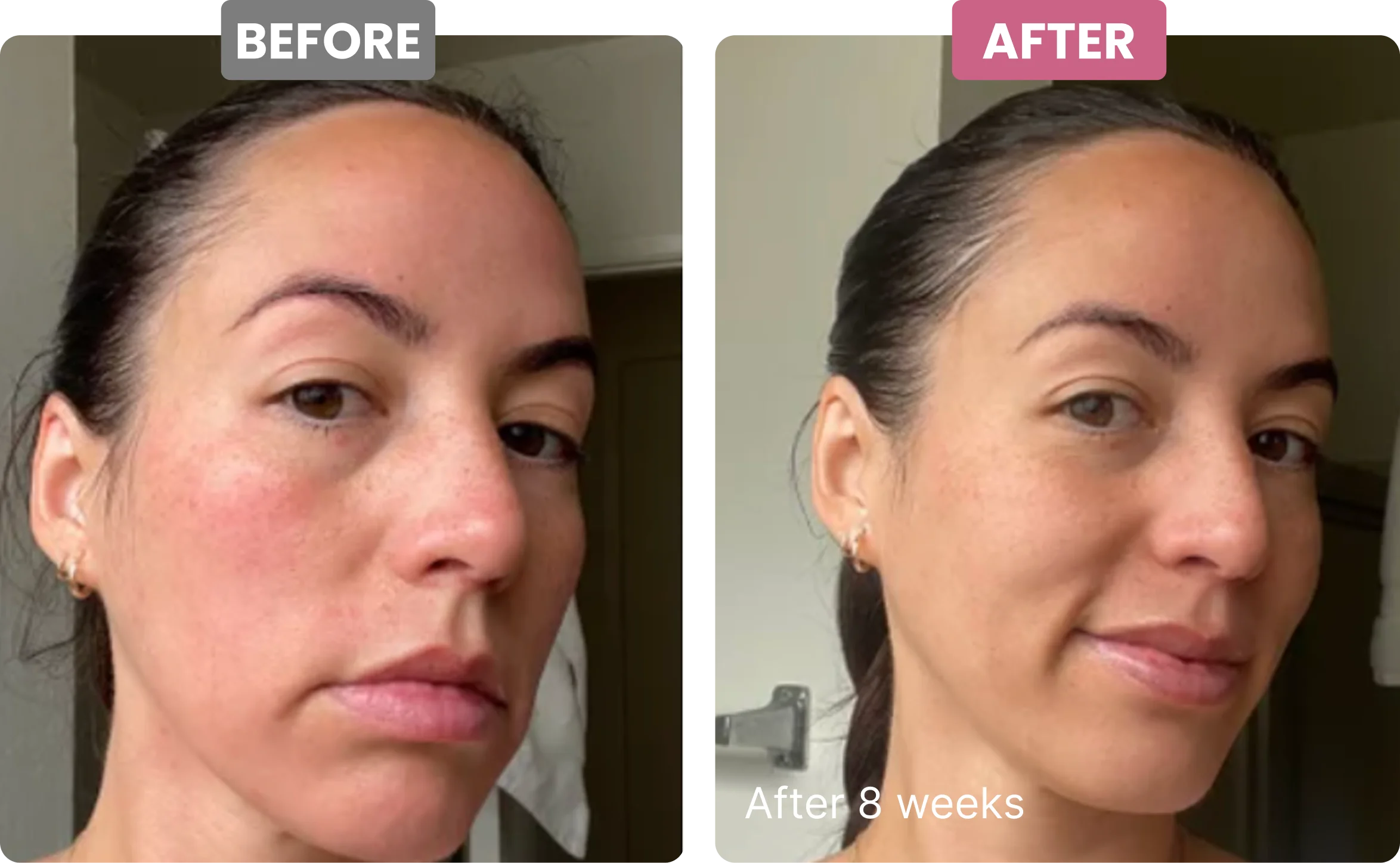 A side-by-side comparison showing a woman's face before and after 8 weeks, with reduced facial redness.