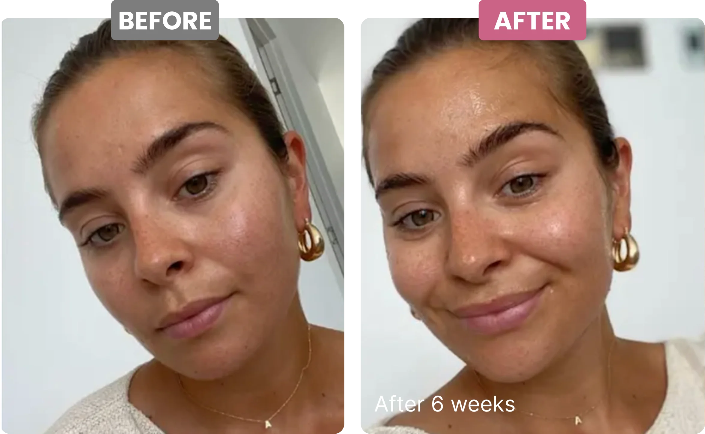A before and after comparison of a woman's face, showing her skin's appearance after six weeks.