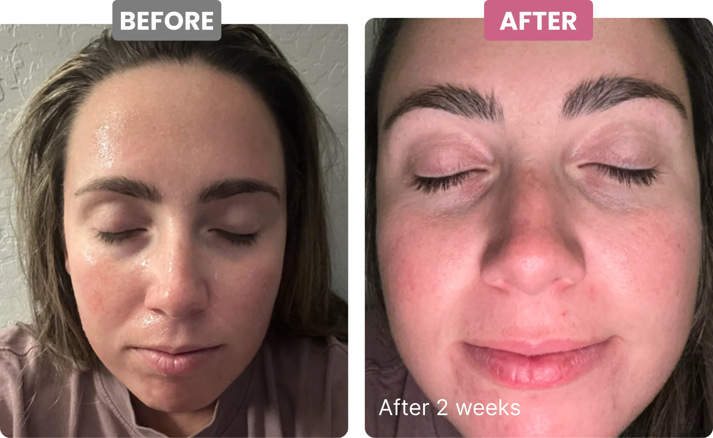 Before and after photos of a woman's face, showing a reduction in skin redness after two weeks.