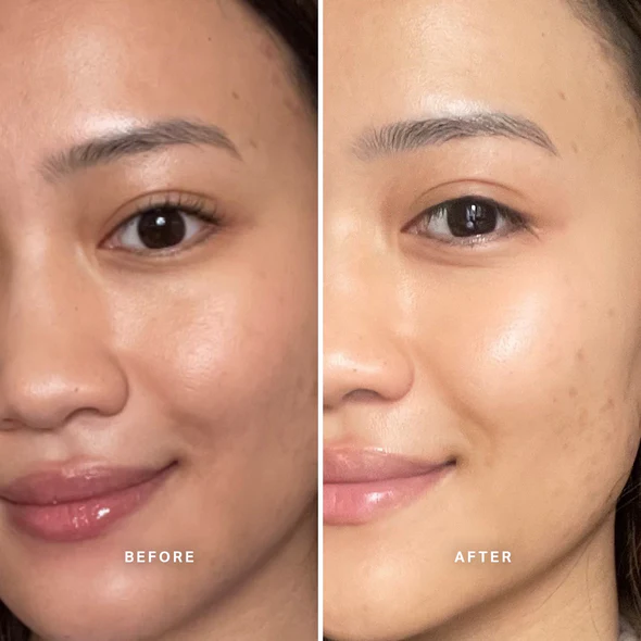 A before and after comparison of a woman's face, showing a reduction in skin blemishes and dark spots.