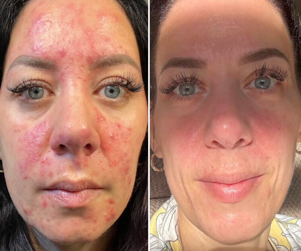 Side-by-side comparison of a woman's face with acne and clear skin.