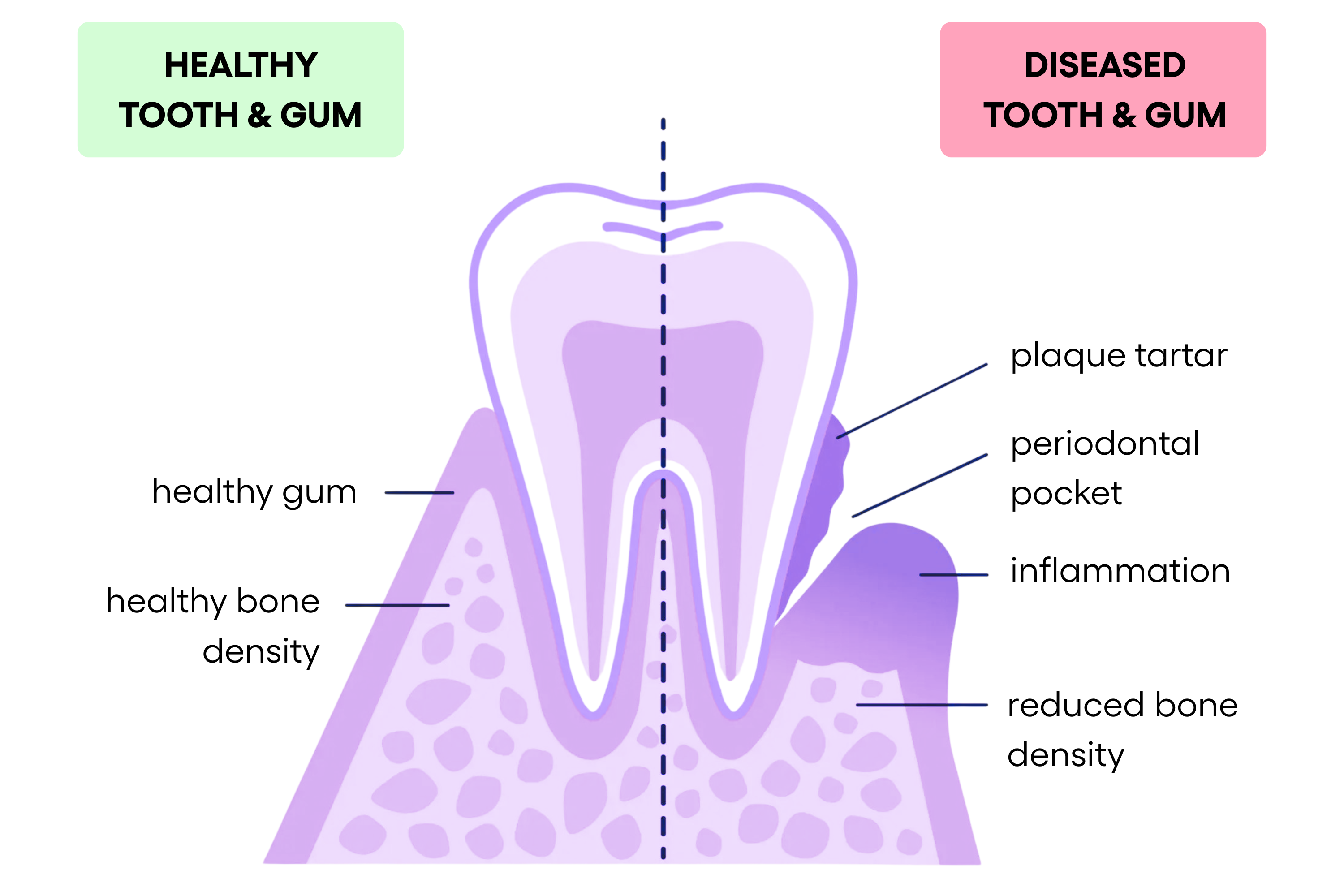 Illustration comparing healthy and diseased teeth and gums.