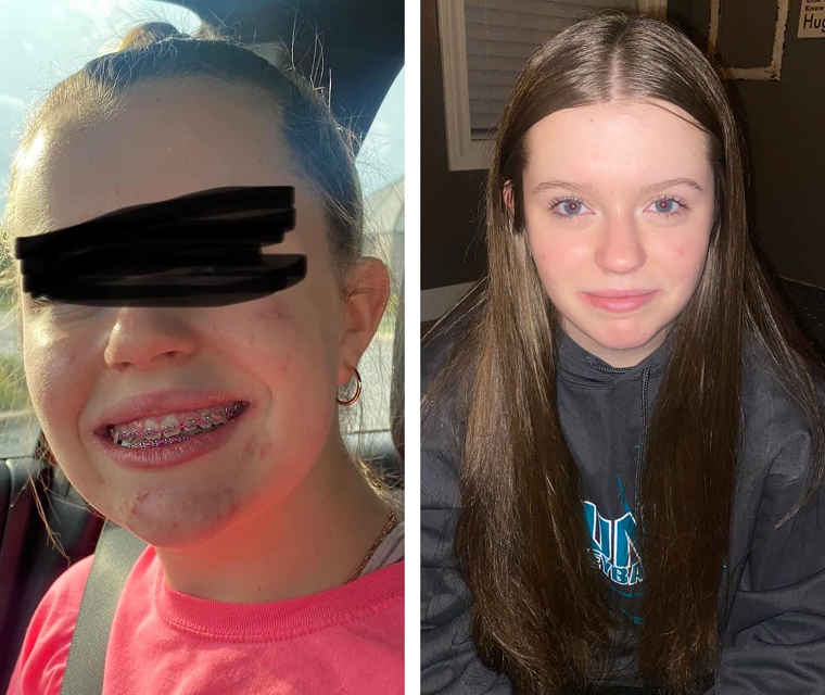 Side-by-side images of a person, one with edited eyes, smiling with braces.