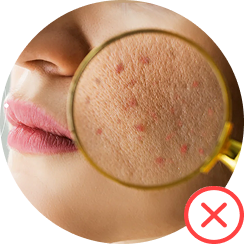 Close-up of skin with acne examined through a magnifying glass, near lips.