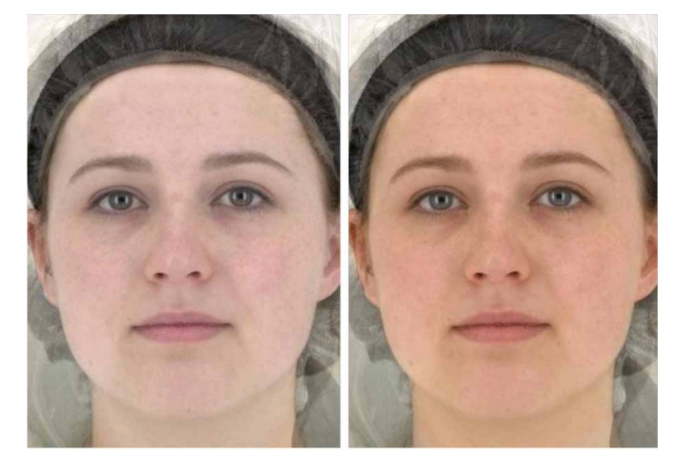 A side-by-side comparison of a woman's face, showing a before and after view of her skin.