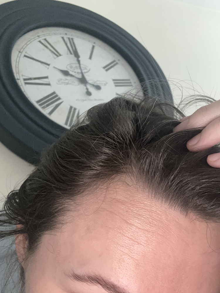 A close-up of a person's forehead and hairline, with a large analog clock in the background.