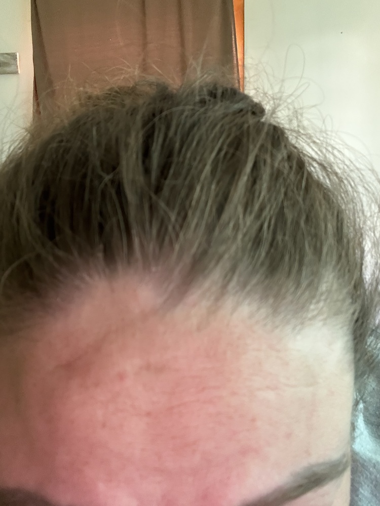 A close-up of a person's forehead and hairline with brown, frizzy hair pulled back.