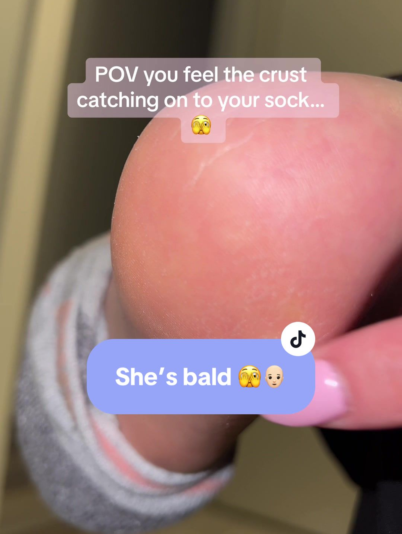 Close-up of a heel with text overlay about crust catching on a sock.