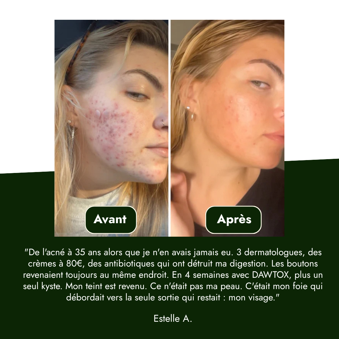 A before and after image showing a woman's face with a significant reduction in acne.