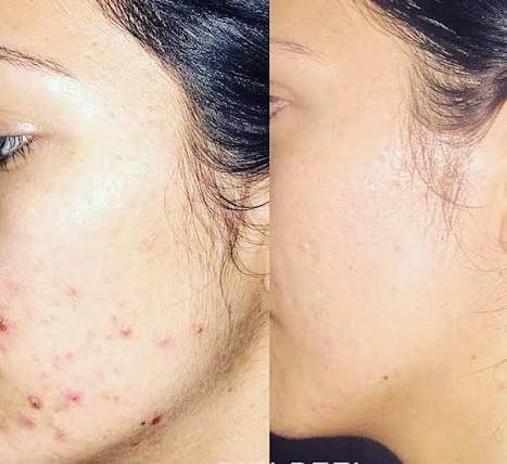 A before-and-after split image showing the reduction of acne on a person's cheek.