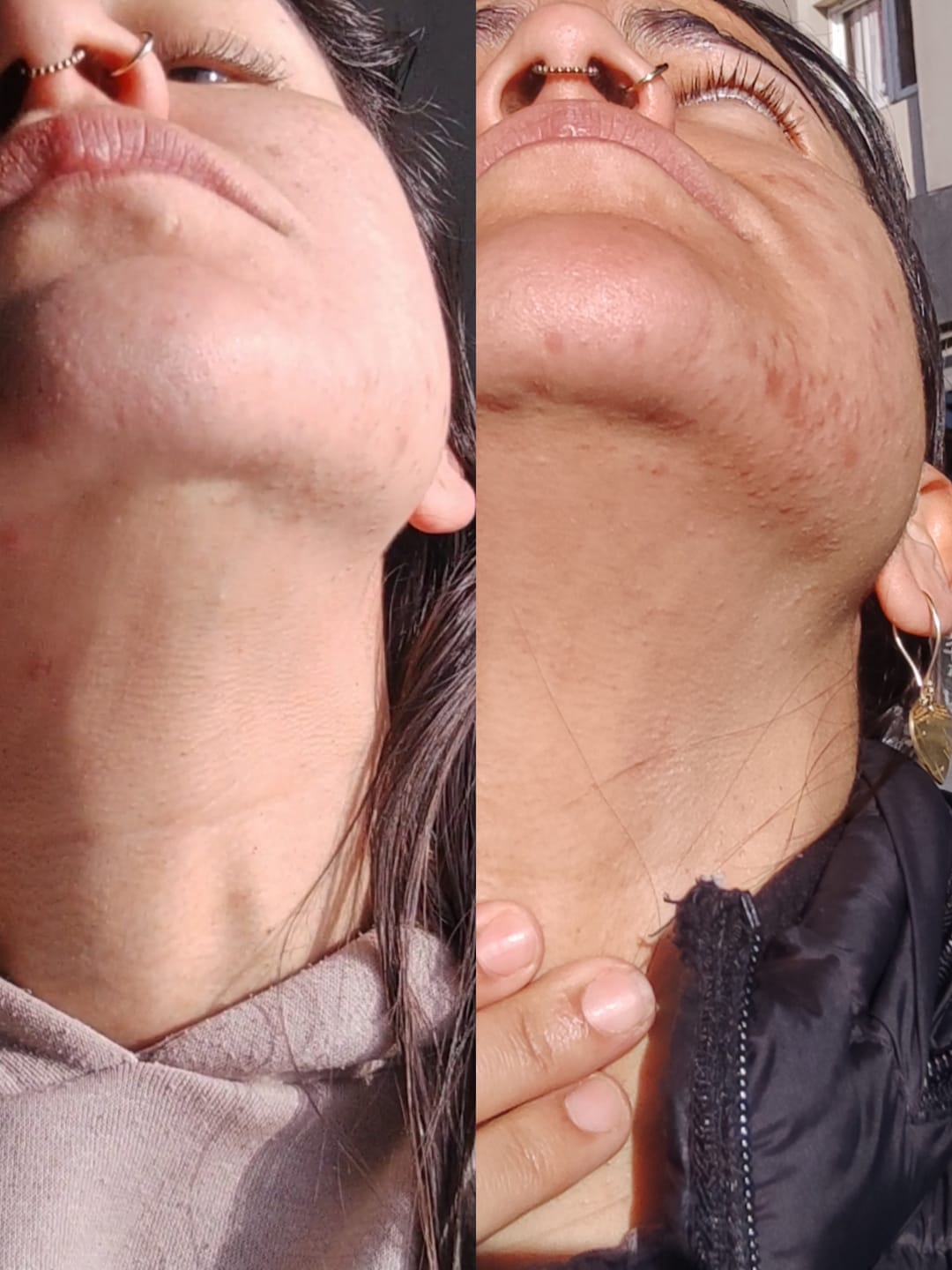 A side-by-side comparison showing a close-up of a person's chin, jawline, and neck area.