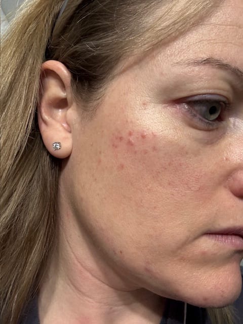A close-up of the side of a woman's face, showing red blemishes on her cheek and under her eye.