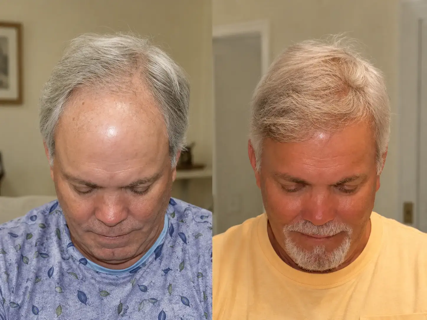 A side-by-side comparison shows a man's hair looking significantly fuller in the after photo on the right.