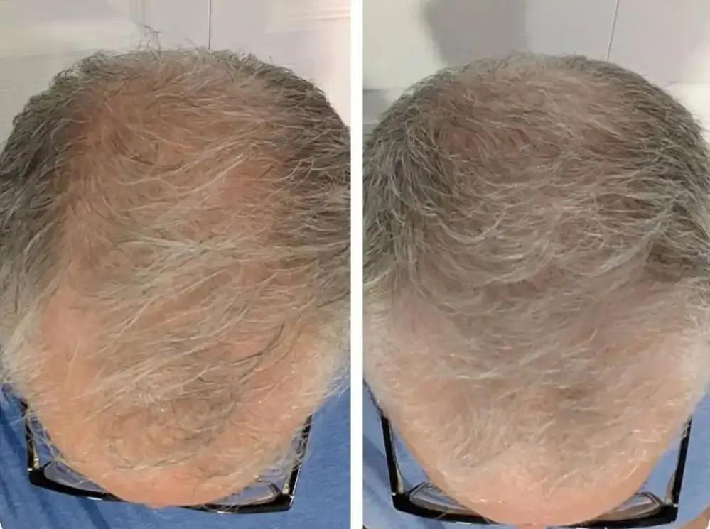 Before and after photos of a man's thinning grey hair, with the hair appearing fuller in the right image.