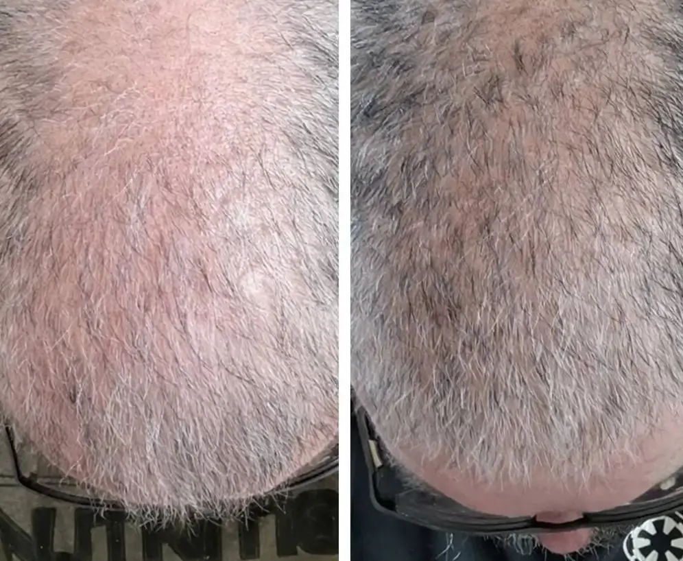 A before and after comparison showing hair regrowth on the crown of a man's head.