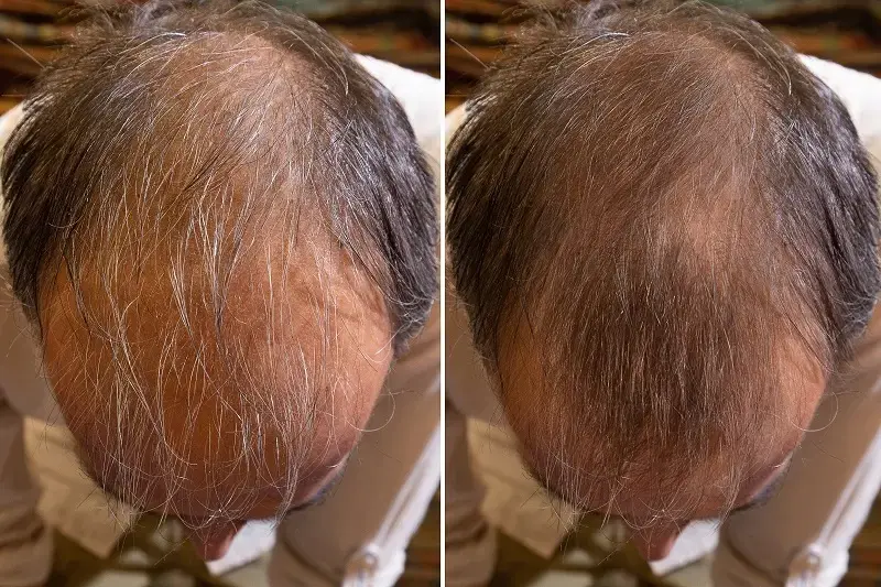 A before-and-after photo showing the top of a man's head with less gray, thinning hair.