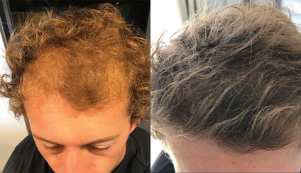 Side-by-side comparison of a person's hair before and after treatment.