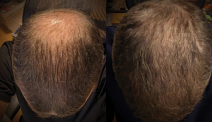 Two side-by-side images showing the top of a person's head with different hair densities.