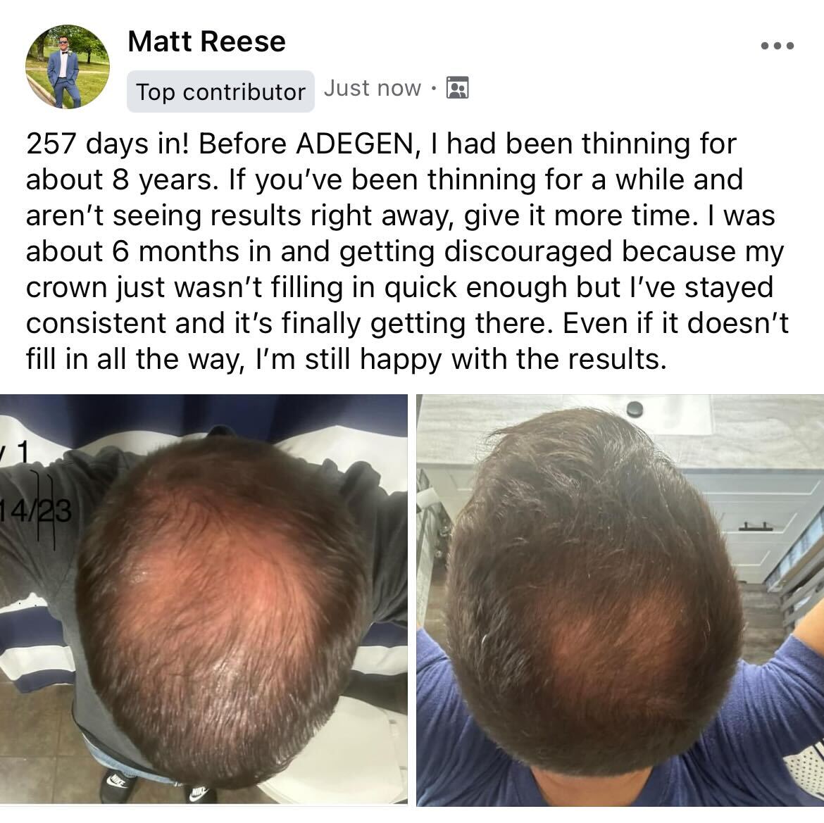 Two overhead photos comparing hair growth progress on a person's scalp.