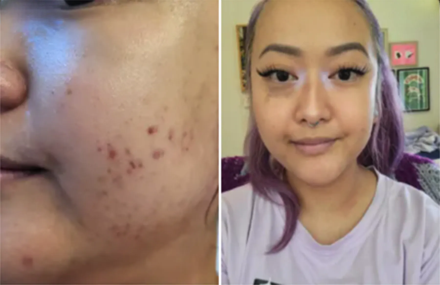 Side-by-side comparison of a woman's face with and without acne.