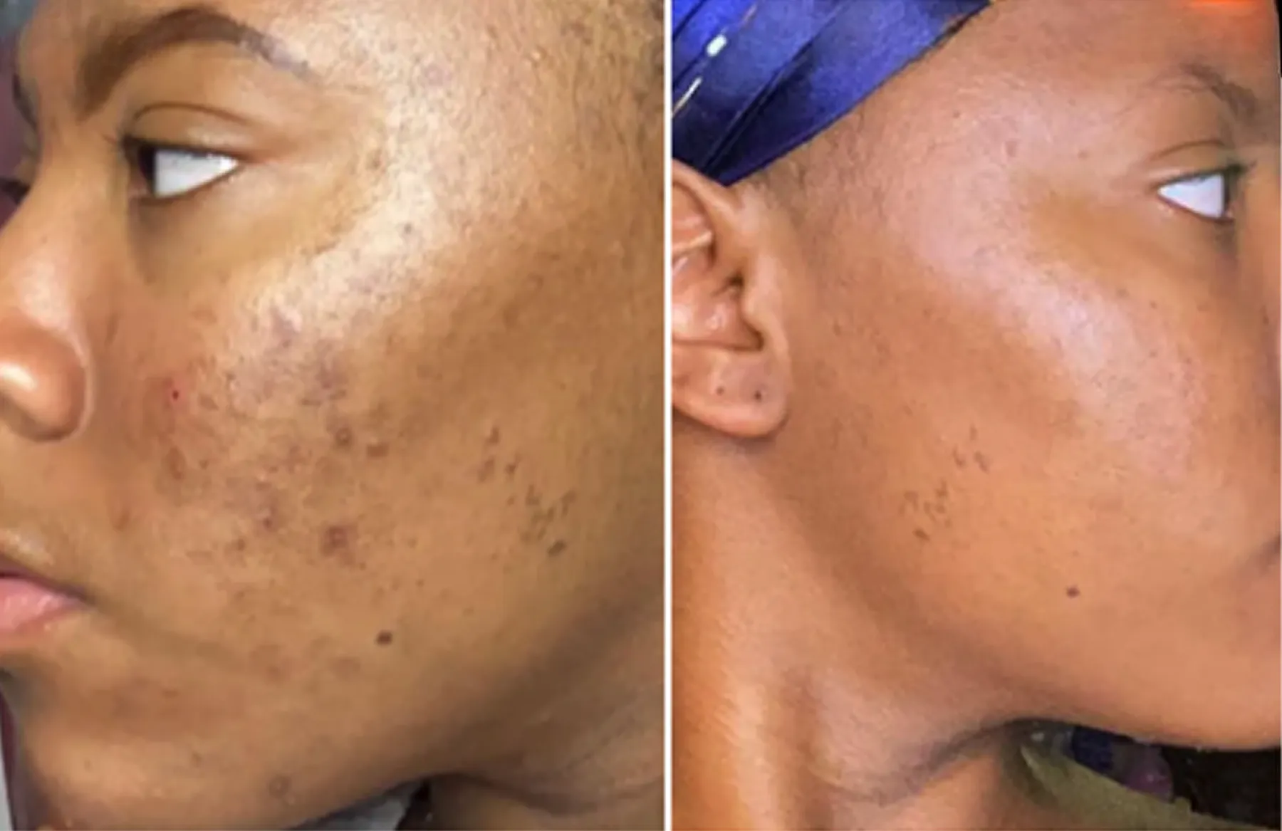 Side-by-side comparison of facial skin before and after treatment.