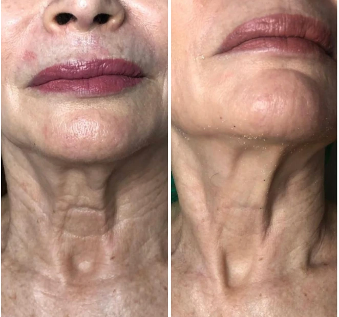 Side-by-side comparison of a person's neck before and after treatment.