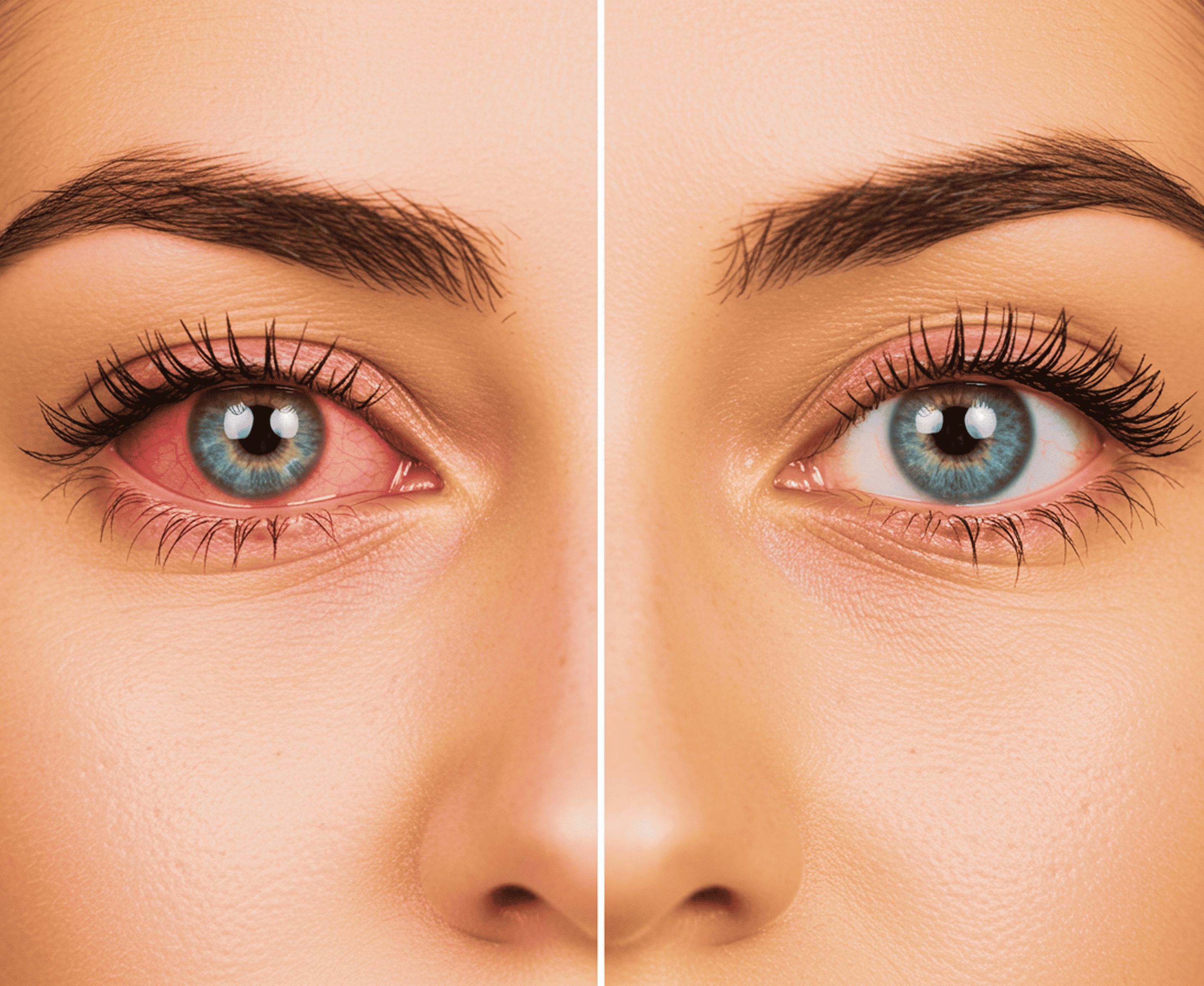 Comparison of an eye with redness and a clear eye.