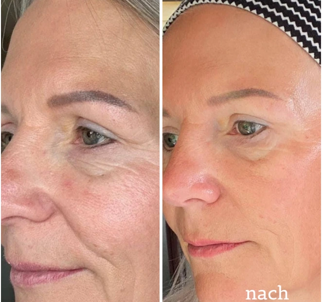 Two close-up side-by-side images of a woman's face showing skin texture differences.