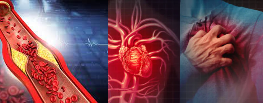 Illustration of a clogged artery, heart, and person clutching chest.