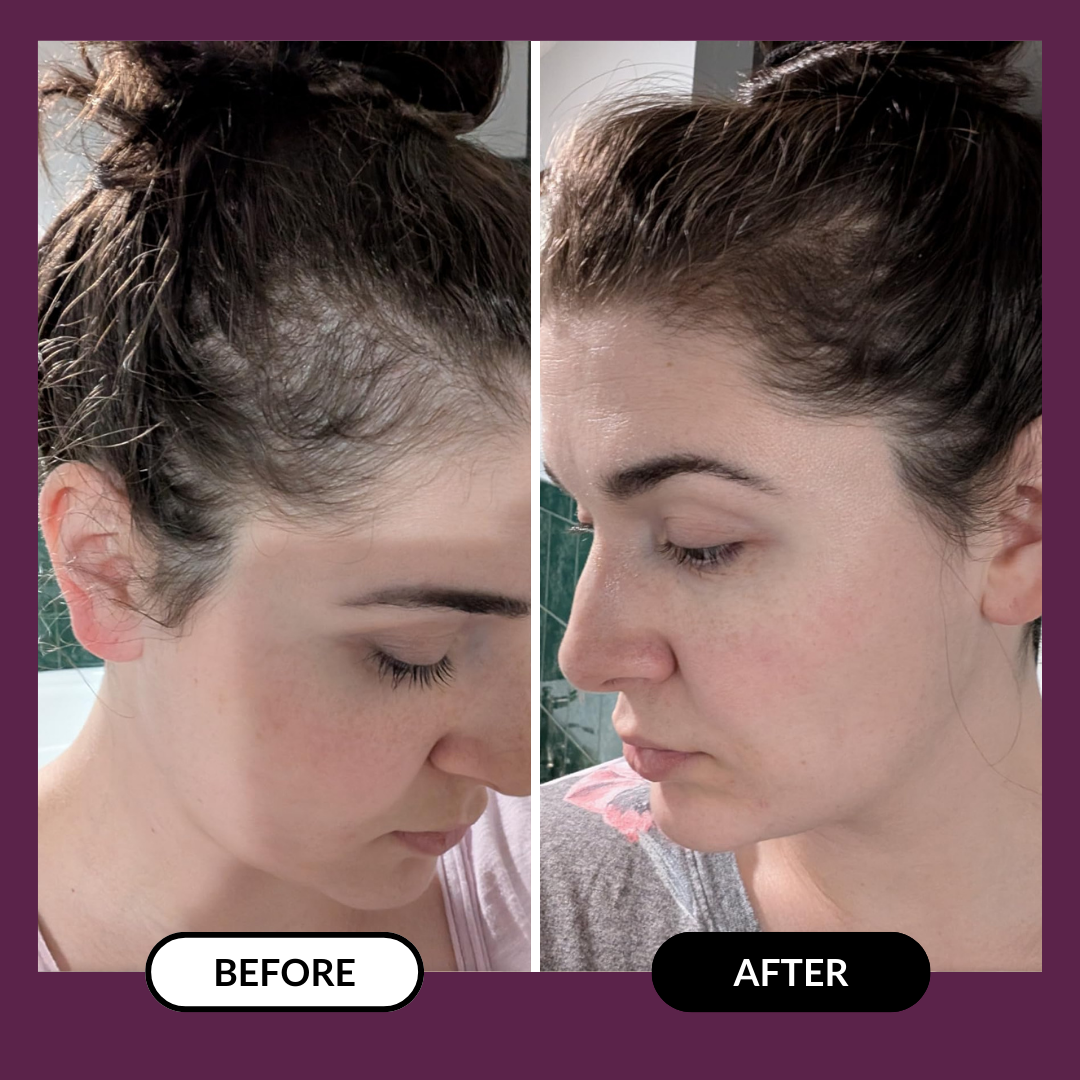 Side-by-side comparison of a woman's hairline before and after treatment.