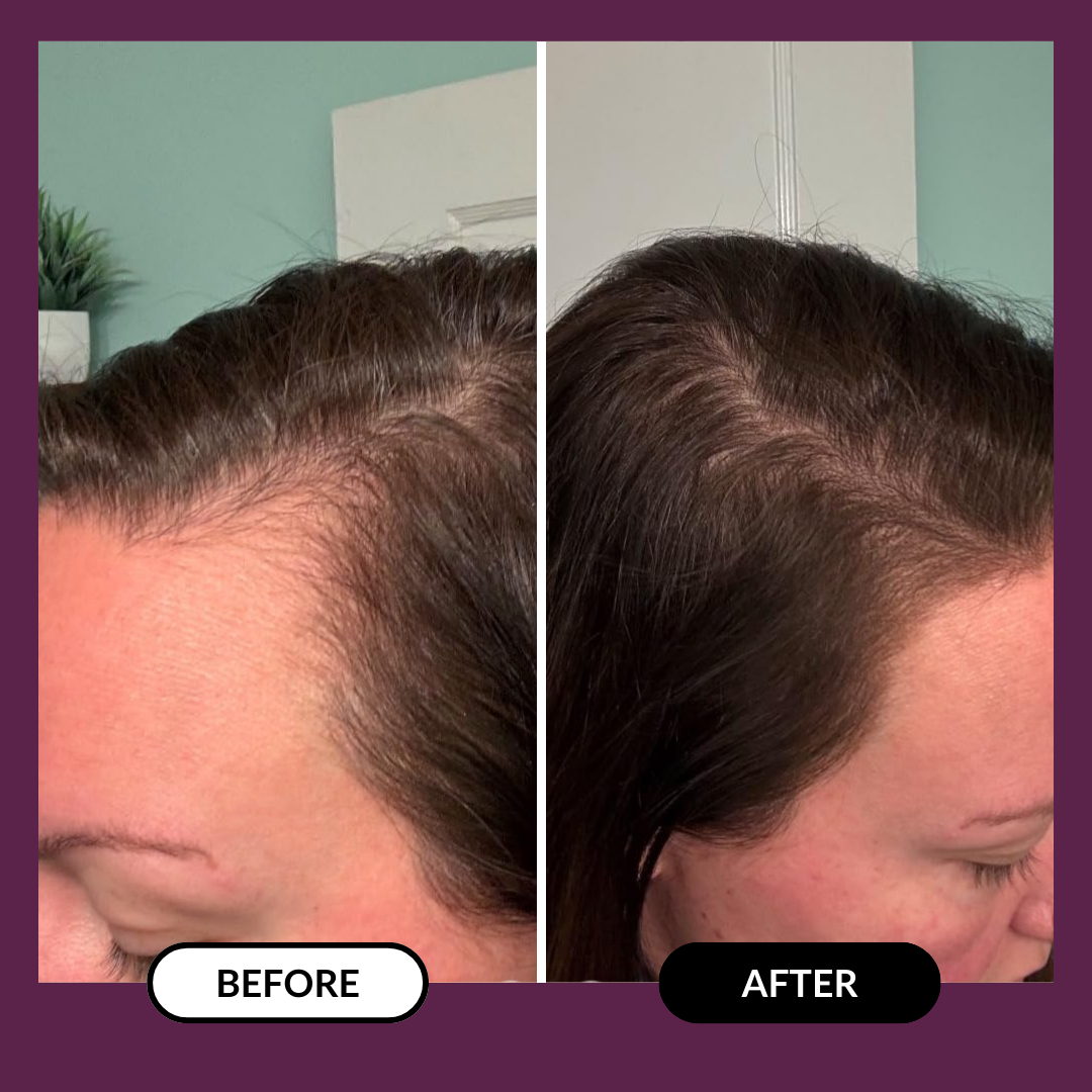 Side-by-side comparison of hairline before and after treatment.