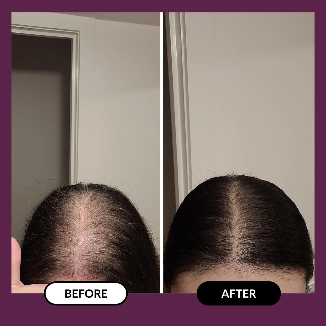 Before and after comparison of hair density on a person's scalp.